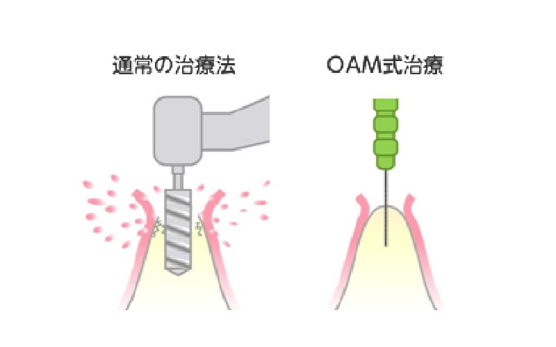 最新のＯＡＭインプラント