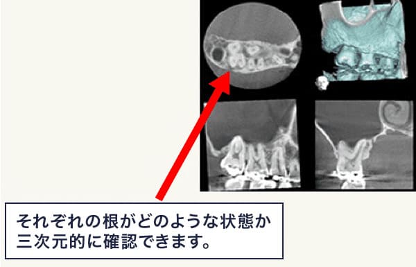 精密根管治療